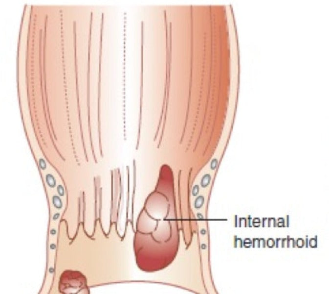 HemorrHeal SUPPOSITORY for internal hemorrhoids ingredients and application