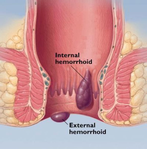 HemorrHeal LIQUID Hemorrhoid KIT (eBook & Ingredients)